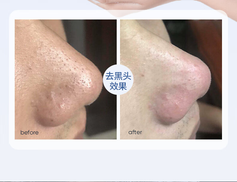 SUMDOY日本进口洗面奶氨基酸男女士控油祛痘除螨收缩毛孔去黑头洁面慕斯 【周期修复祛痘】120ml*2瓶