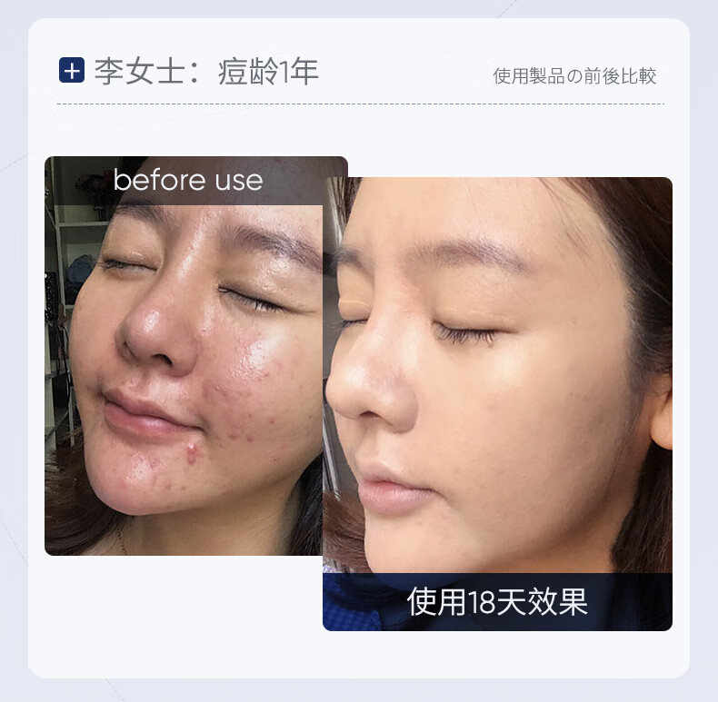 SUMDOY日本进口壬二酸祛痘印痘坑修复膏去痘红肿淡化痘印痘疤女男士 【94%顾客选择】周期修护60g