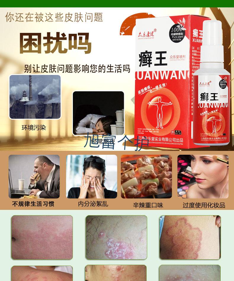 疹牛皮手足癣股癣大腿内侧瘙痒皮肤止痒膏头皮癣汗斑花斑癣顽癣乳膏 2