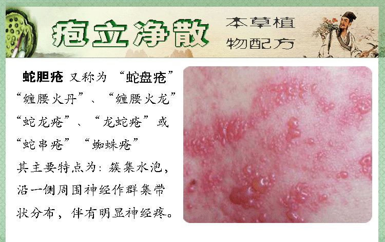 妍叶堂带状疱疹神经痛用药病毒性带状疱疹外用药蛇盘疮缠腰 蛇胆疮蛇