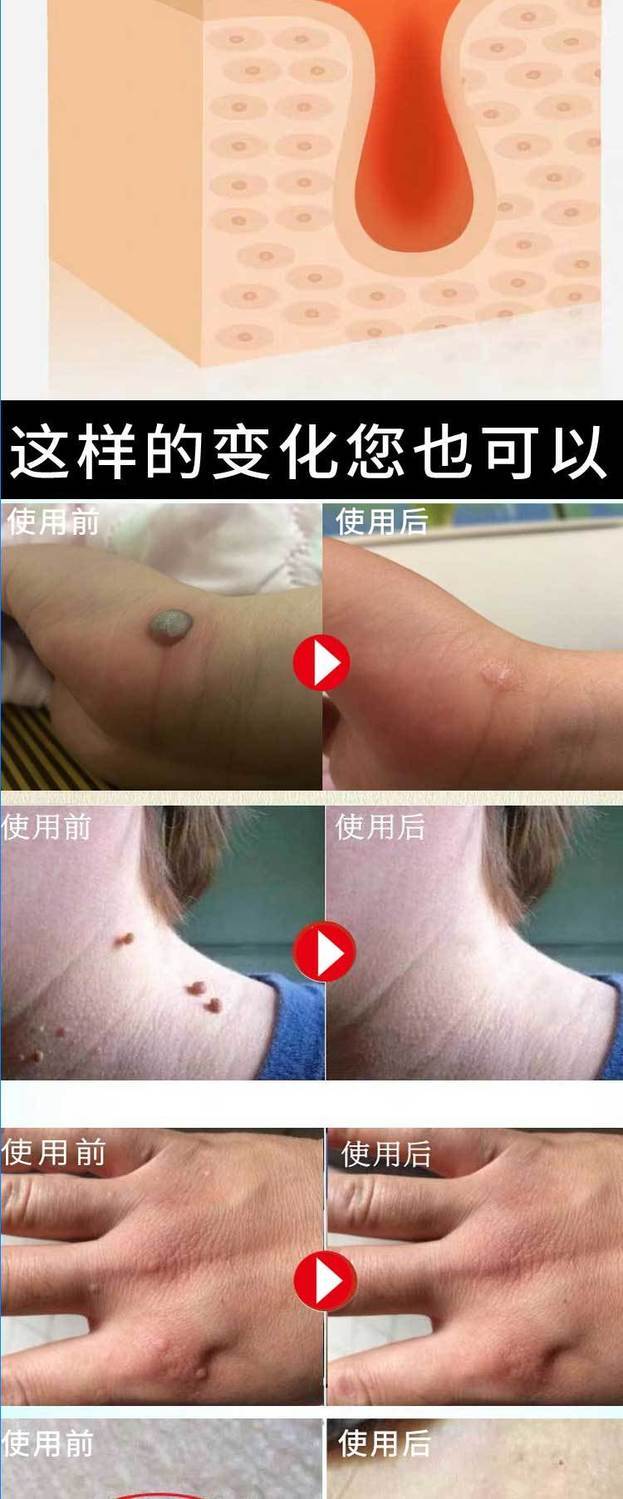 疣瘊净一涂就掉无痛去除脖子小肉粒丝状尤扁平尤刺猴肉瘊i疣瘊净液多