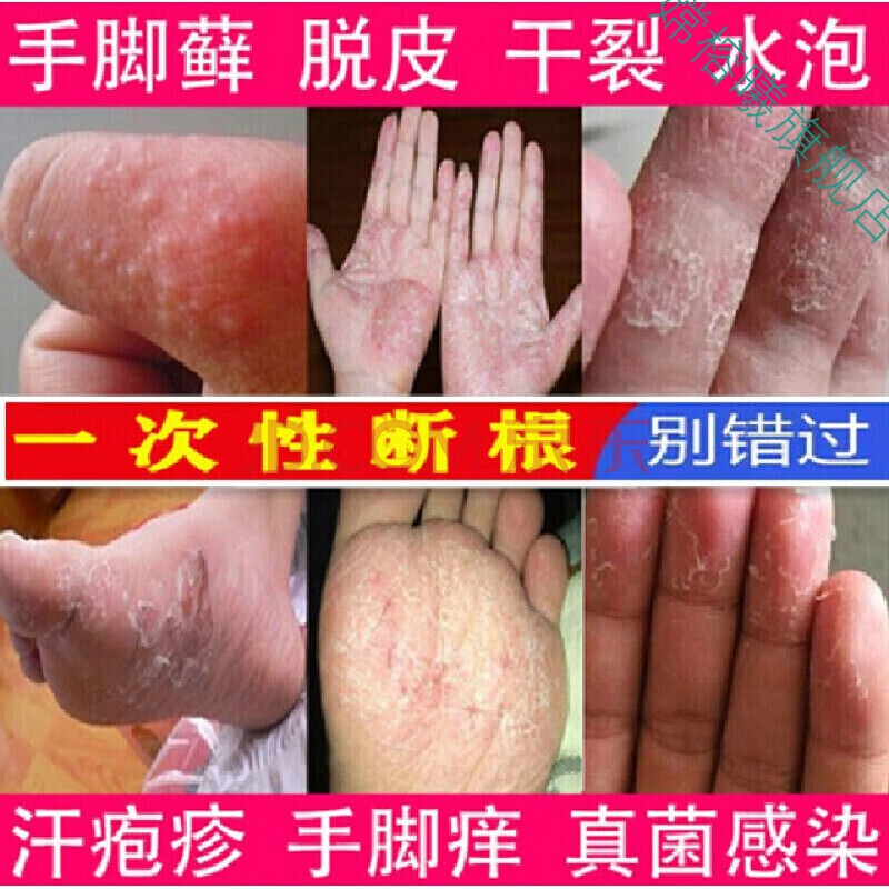 手i癣脱皮鹅掌风手i癣膏真菌i感染脱皮干裂手足i癣水泡湿ii疹止i痒去i