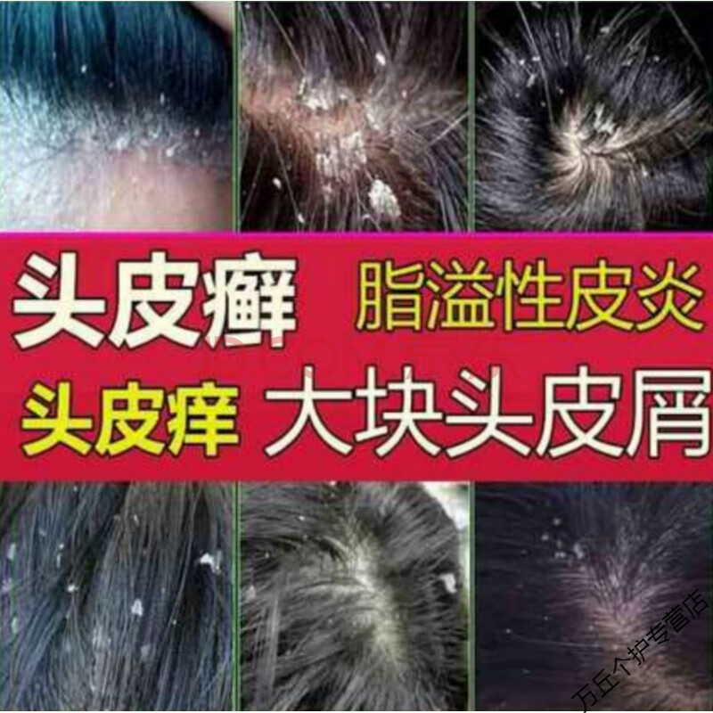 治大块头皮屑 毛囊炎去屑止痒控油洗发水 脂溢性皮炎 牛皮银屑头皮癣
