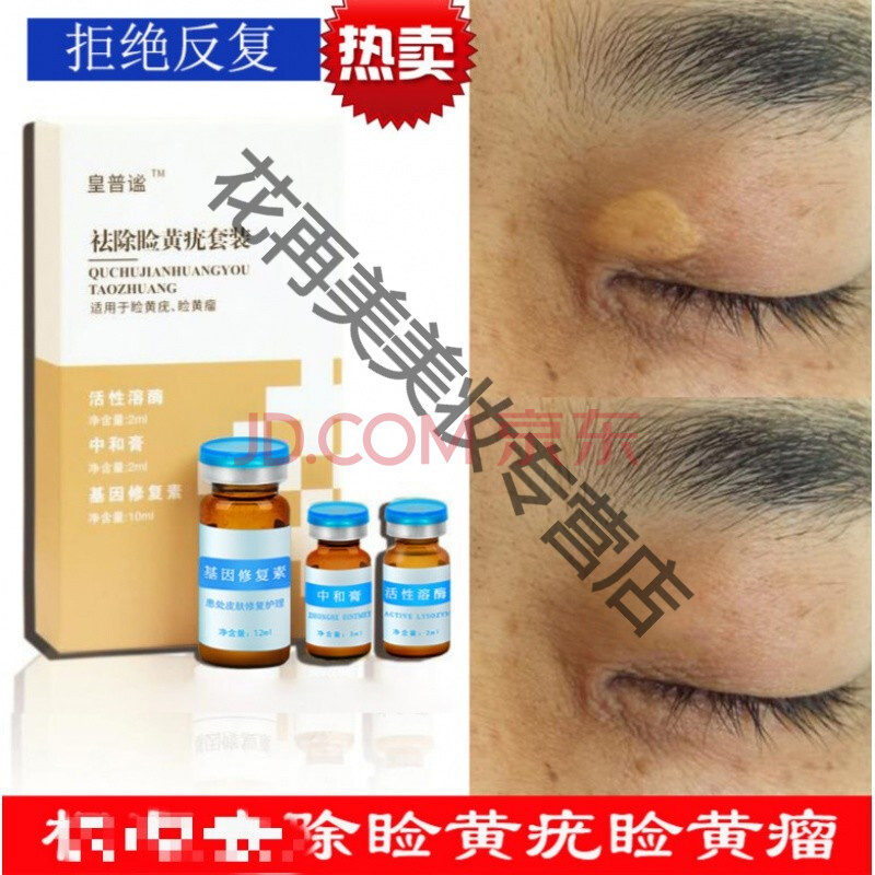 睑黄疣去除睑黄疣睑黄瘤斑膏圆眼睑黄斑瘤健康膏长黄色瘤眼部黄睑疣瘤
