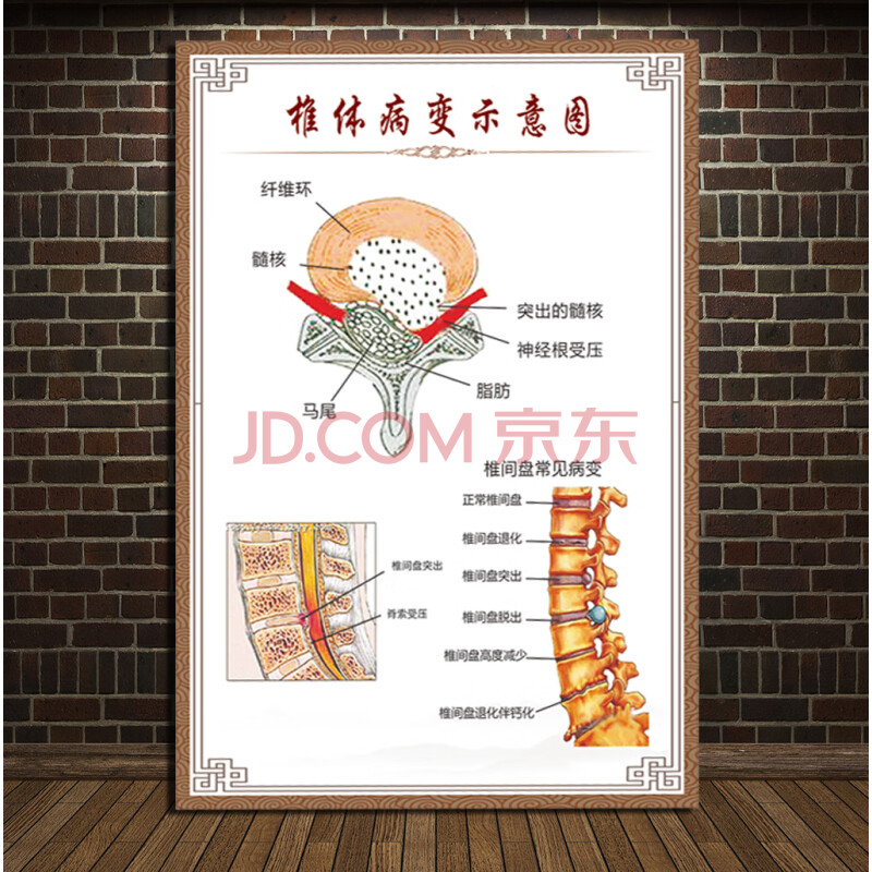 常见病变颈椎脊椎息图骨骼挂图医院腰椎间盘突出墙贴 椎体病变示意图