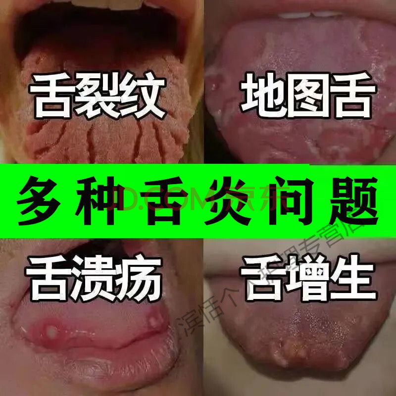 口腔扁平苔藓舌炎烂舌头舌头发白舌头起泡口干舌乳头炎灼烧感疼痛