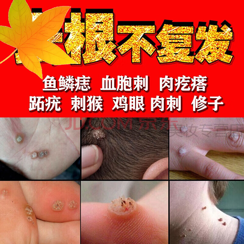 去除肉i刺猴跖i疣祛修子鸡眼箹治鱼鳞i痣贴膏血胞刺点瘊i子痦候尤净根