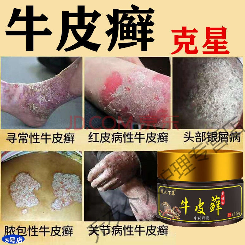 专用牛皮l癣te效箹头皮手足l癣顽固性银l屑病ke星老偏方皮肤止痒箹l膏