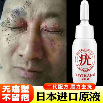 去脖子肉粒足部老茧疣瘊灵扁平l疣脖子腋下丝状l疣