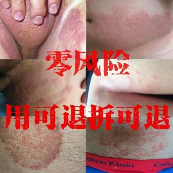 肤毒膏治牛皮体头藓去大腿根内侧股藓癣膏痒软膏皮肤止痒外用药膏