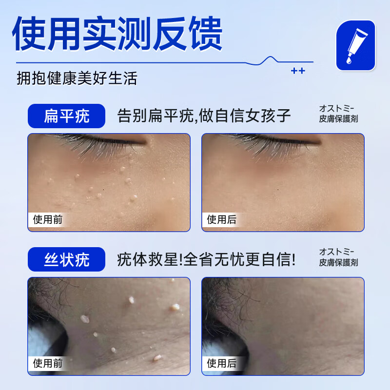 廾卜制药疣体脱落膏扁平疣专用丝状疣尖锐湿疣跖疣颈部疣瘊灵小肉粒疣克疣
