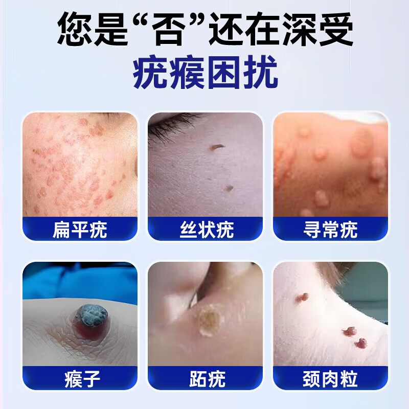 Moihanr扁平疣专用去丝状疣跖疣尖锐湿疣瘊灵脖子小肉粒祛疣型疣体脱落膏