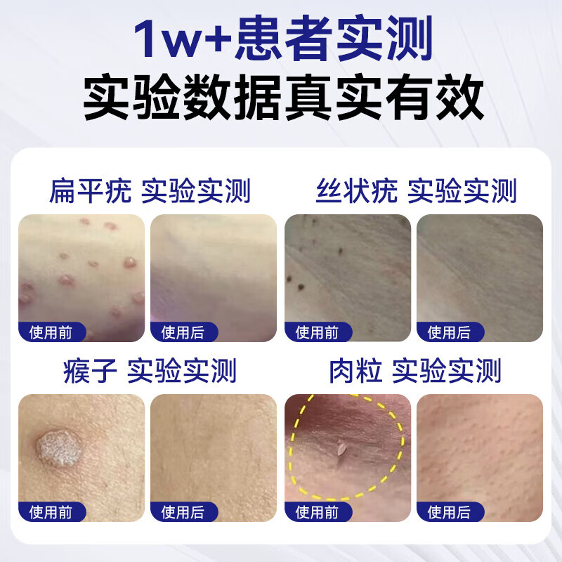 Moihanr扁平疣专用去丝状疣跖疣尖锐湿疣瘊灵脖子小肉粒祛疣型疣体脱落膏