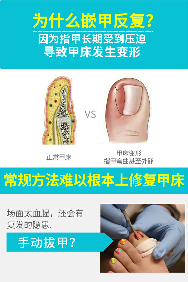 巧固 甲沟炎嵌甲矫正器拉拉贴脚趾甲专用指甲剪刀套装