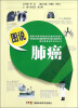 图说肺癌