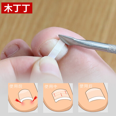 

Muding Dingzheng patch toenails orthodontic correction armor correction special nail clippers pedicure set
