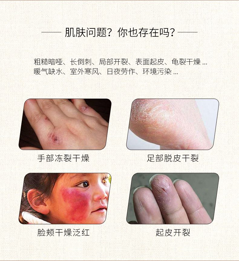 隆力奇蛇油膏 三效防护蛇油膏80g 纳米蛇油护手霜秋冬保湿补水缓解