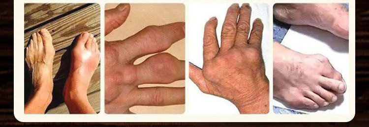 严选好物华陀风湿透骨膏膝盖疼痛关节手指变形红肿僵硬类风湿老寒腿3