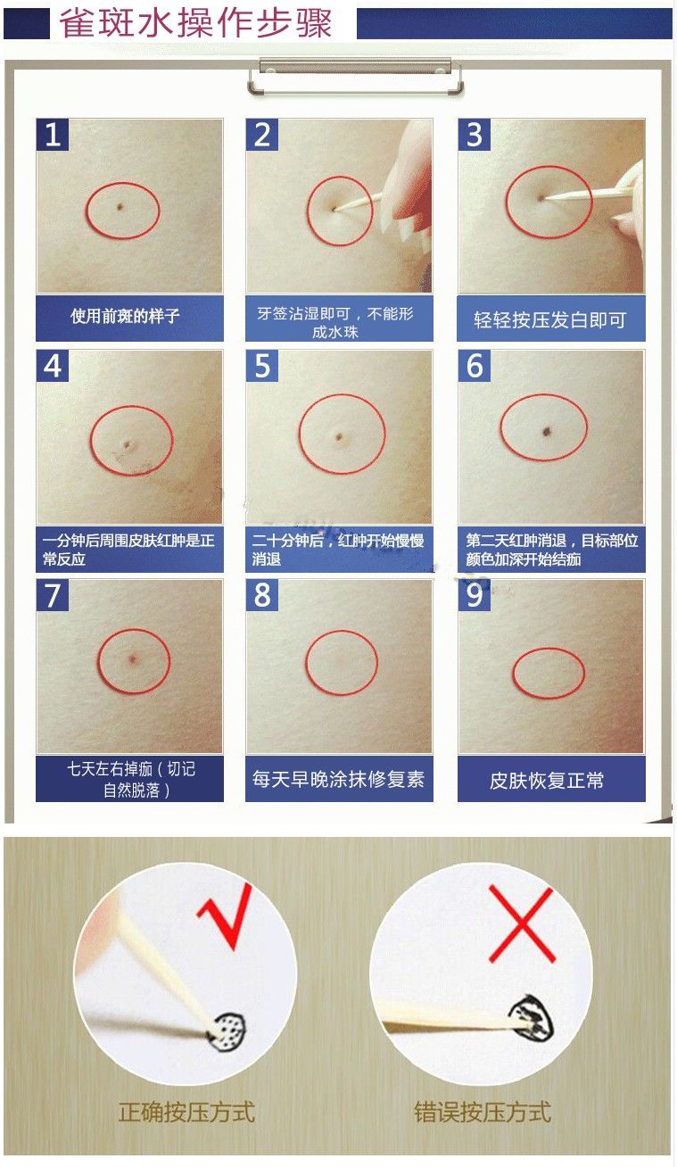 点斑雀斑净产品去1斑水去1斑点去蒙脸沙苍蝇屎等黎妃除痣灵1只修复素