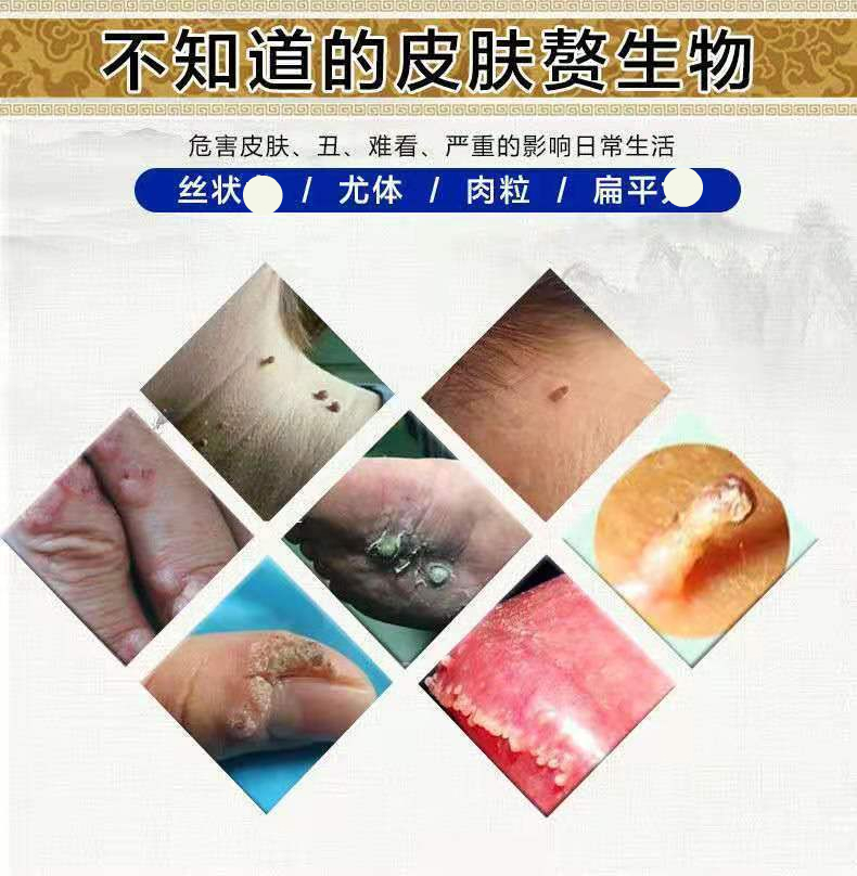 尤力可清去脖子小肉粒颈部丝状尤胸部腋下尖锐湿疣重度发9盒