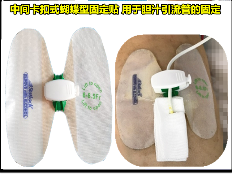 胆汁引流管蝴蝶型固定贴中间卡扣型固定装置6-8.5胆管固定贴 6-8.