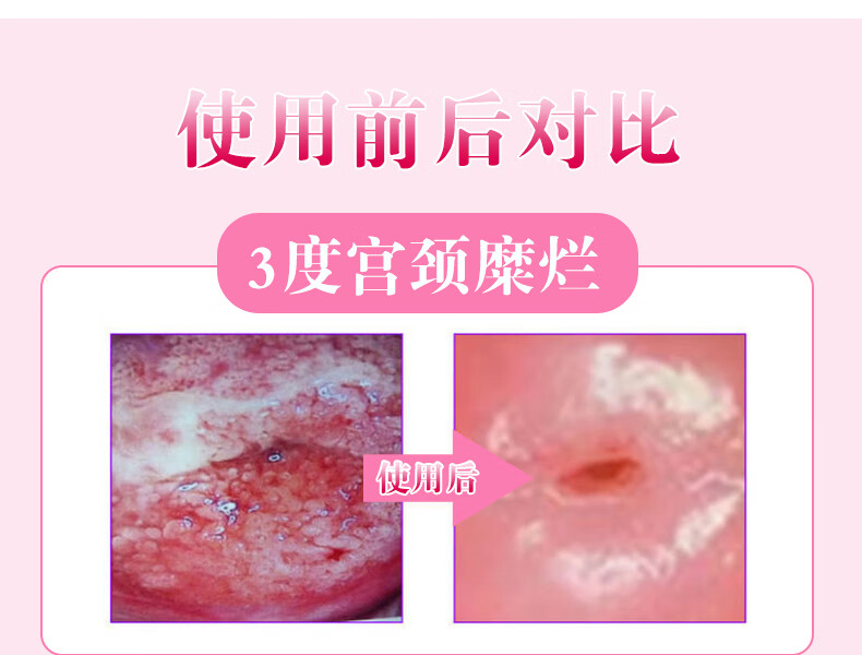 hpv抗干扰素凝胶女性产后私护炎瘙痒异味12盒hpv多类高危型