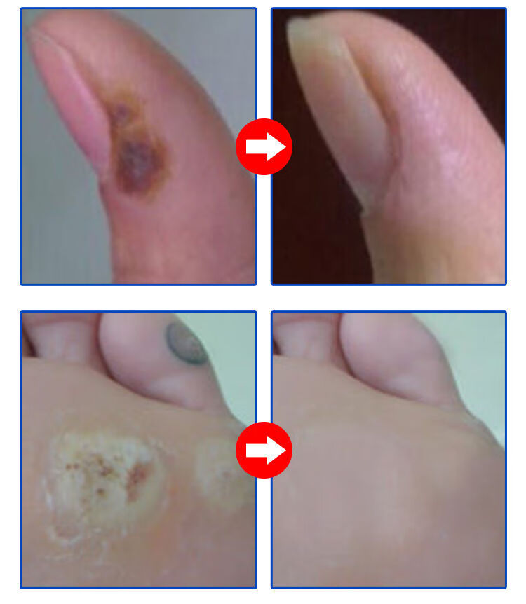 克优膏尖锐丝状寻常扁平忧足部霜手足疣灵疣疣净膏 一支装【草本提取