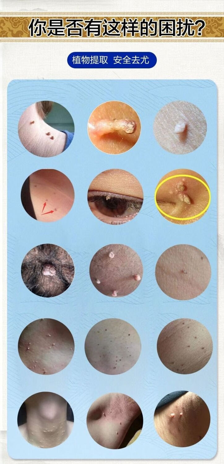 克忧液去除丝状尤脖子尖锐湿尤扁平尤丝状尤腋下肉粒膏液组合 3套装