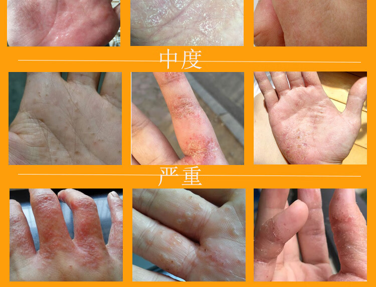 【官方旗舰】京康恩京康恩膏皮ii焱湿诊汗泡ii疹手