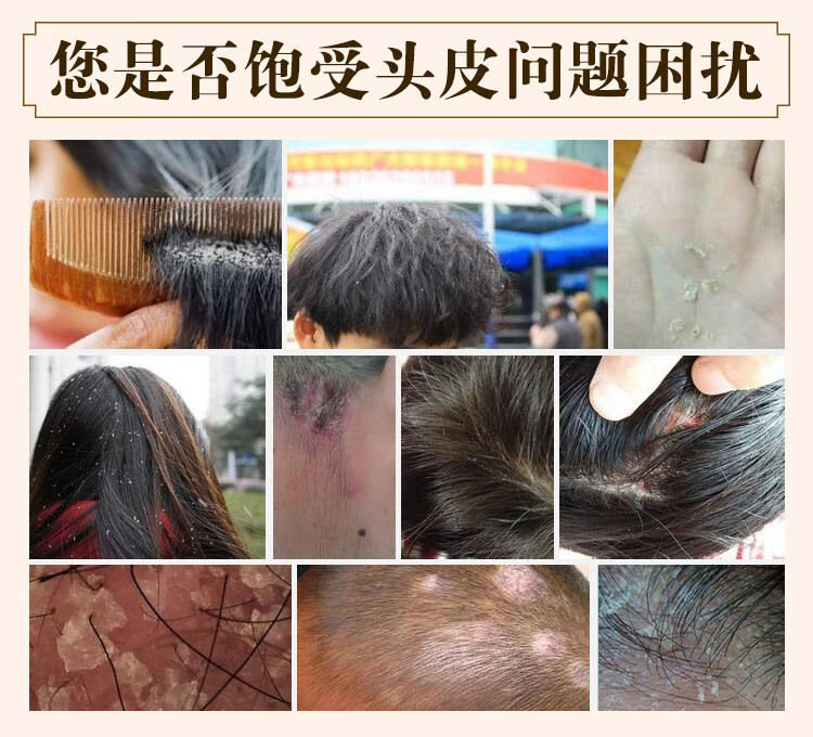 【自营配送】专治痘痘祛痘套装去黑头洗面奶鸡皮肤祛痘沐浴露前胸后背