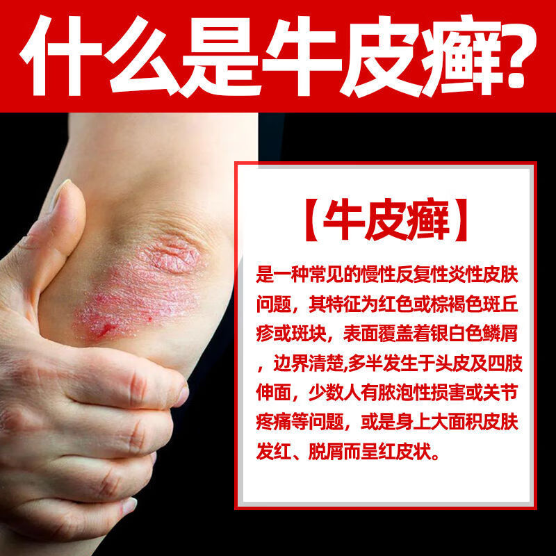 大药房直售 华北制药癣毒清冷敷凝胶外用手足癣体癣牛皮癣花斑癣股癣