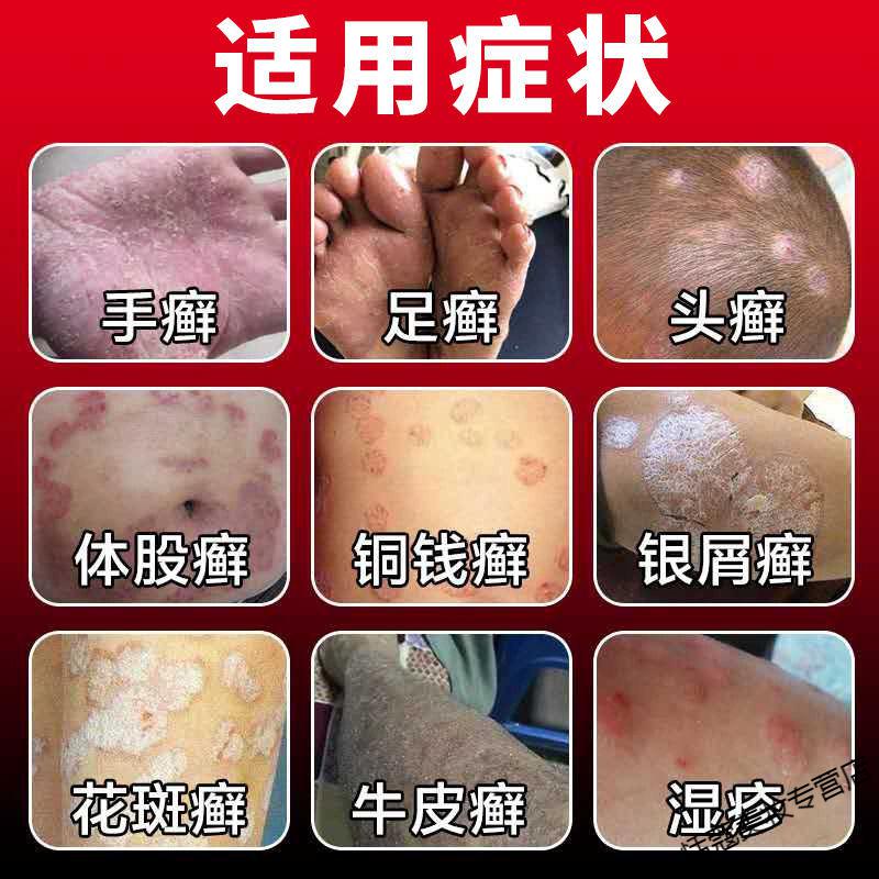 官方维肤灵乳膏报恩堂医师指导使用一支装