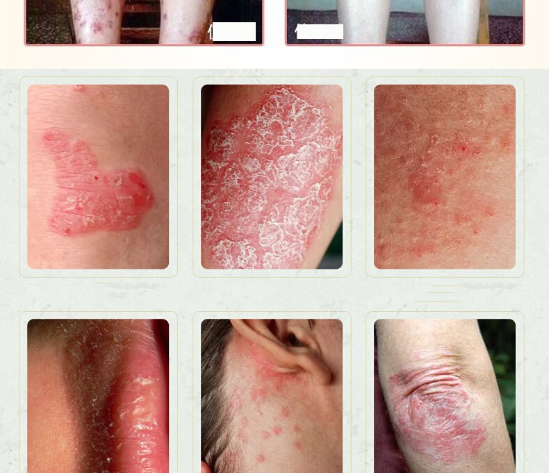 癣王喷剂手足体大腿内侧瘙痒真菌感染止痒液皮肤外用癣喷剂皮肤止癣股