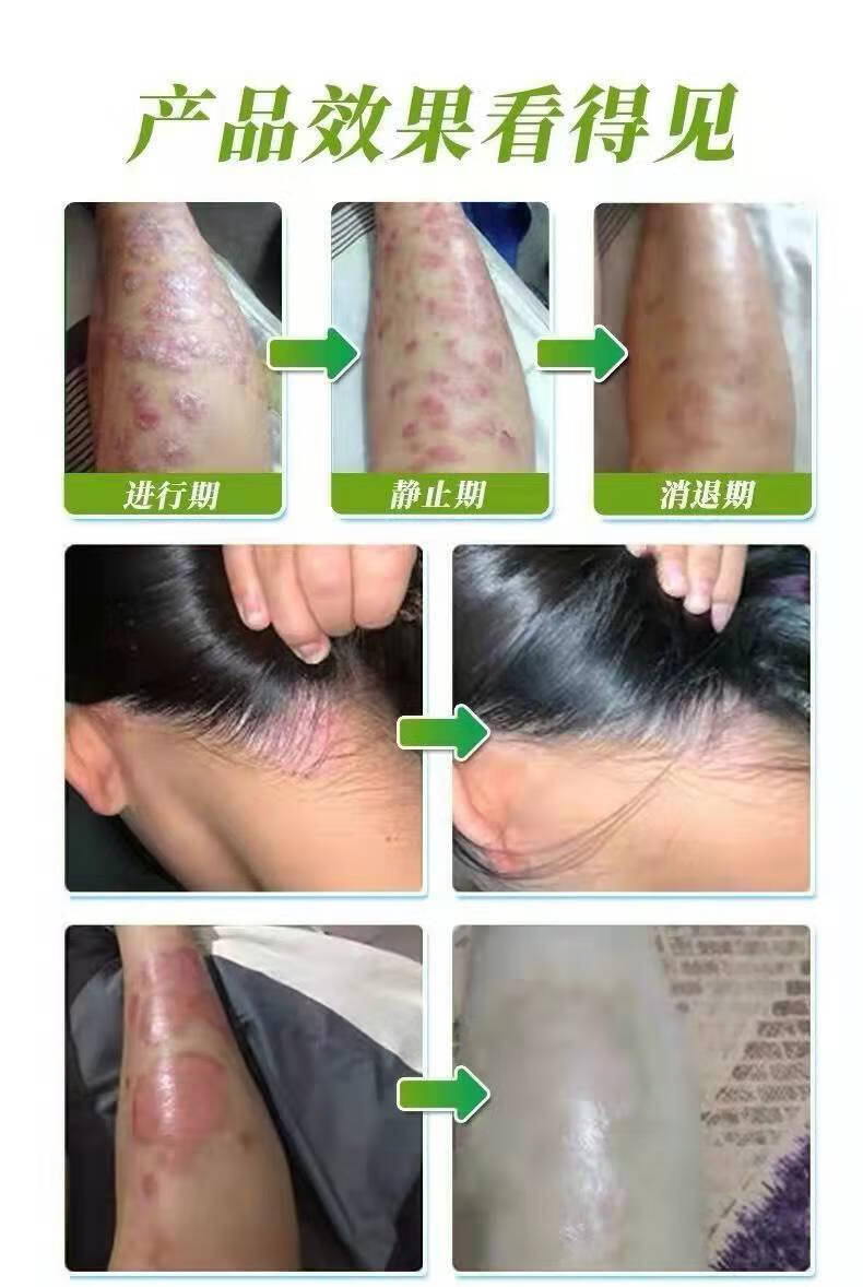 【官方自营】复方黄柏祛l癣搽剂 初肤堂复方黄柏祛l癣搽剂治去l根喷剂