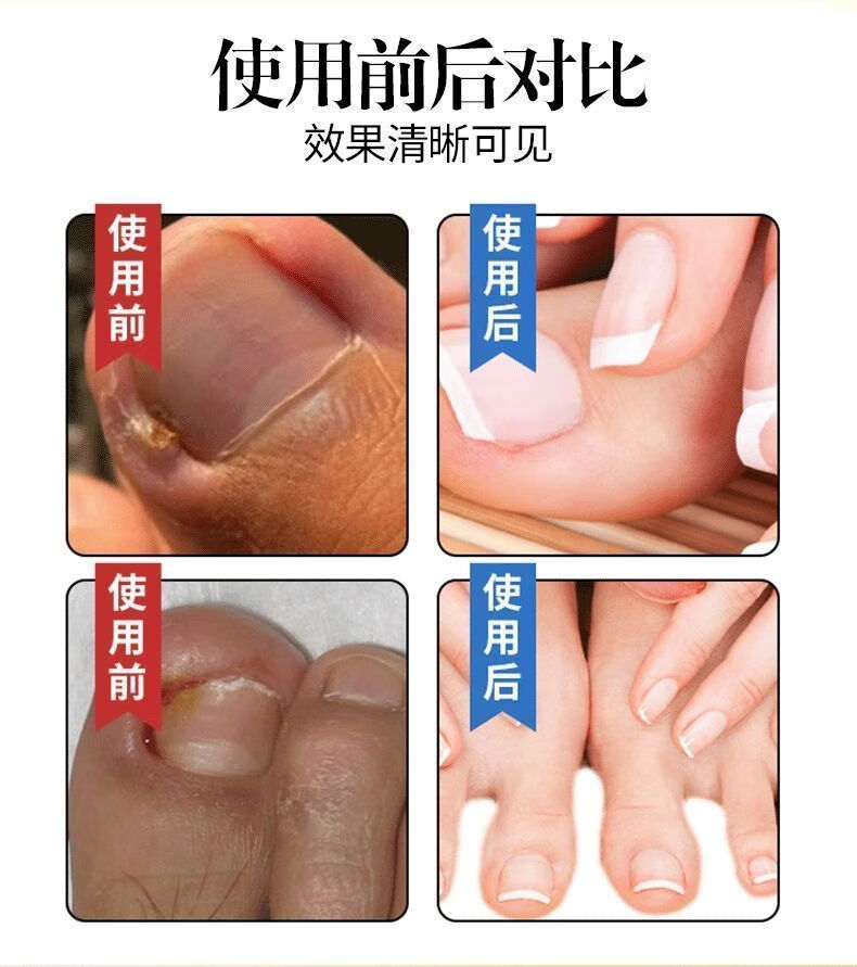 官方旗舰精品浅i米草14号普圣友甲勾二号乳膏软膏2号14号康甲宁甲沟脓