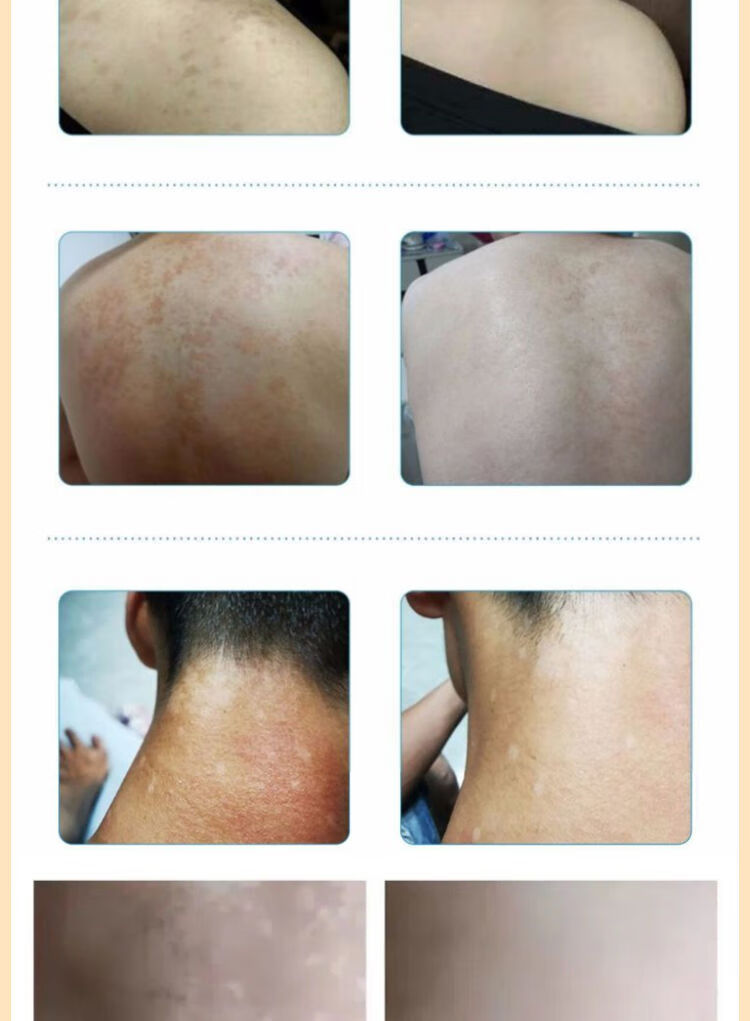 汗斑专用iii药汗斑净胸前背部片状去汉斑花斑藓火斑白斑膏喷剂 大面积