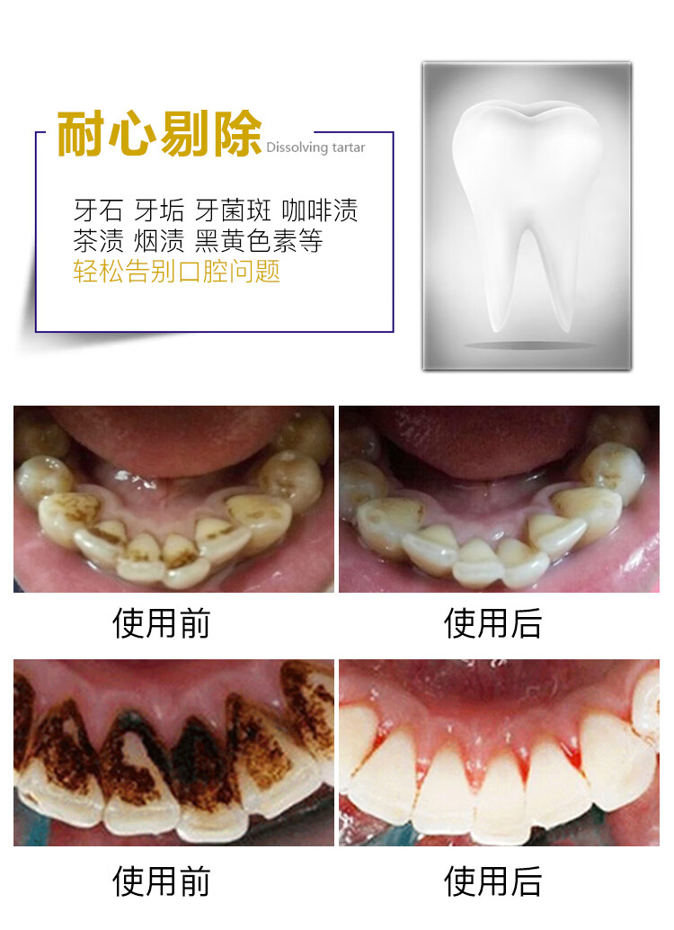 牙垢牙结石清除小窍门图片