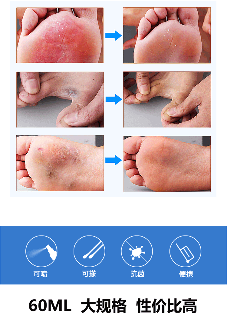 联苯苄唑溶液喷剂 60ml 治疗各种皮肤真菌病 手足癣 体股癣 花斑癣 本