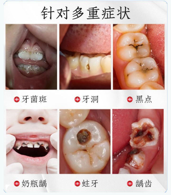 牙齿洞型分类图片