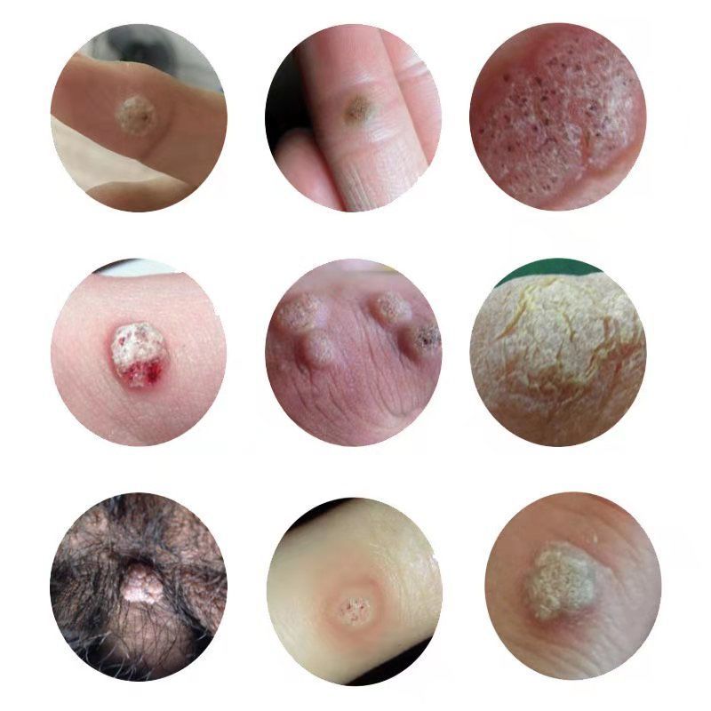 克l尤膏去扁平i疣神器膏肉i刺猴子去i疣灵病毒疣克星 克i疣膏 5盒巩固