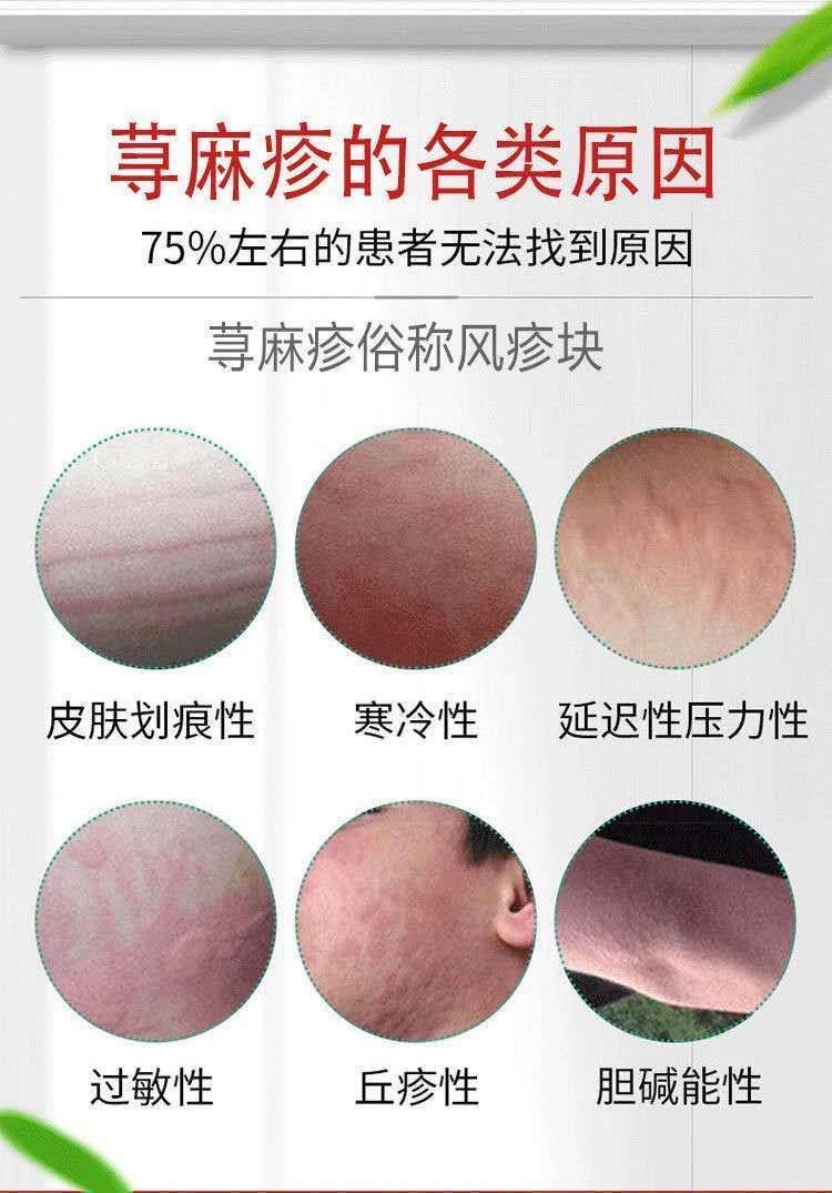 贵州苗药黄皮肤乳膏治荨ll麻ll疹皮肤瘙痒过敏止痒膏寻荨ll麻ll疹风团