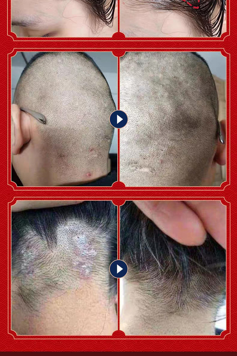 南京同仁堂治毛囊焱炎洗发水去屑脓包真菌头皮藓除螨虫控油头皮藓疙瘩