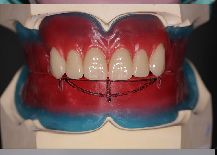 牙科美学分析嘴唇全口吸附性义齿排牙口腔工具齿科技工树脂牙祥匠