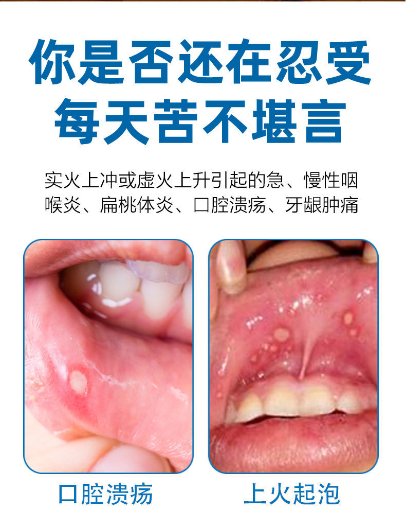 盛世三誠牙康寧口腔潰瘍噴劑靈液爛嘴巴上火起泡止x痛口舌頭生瘡潰瘍