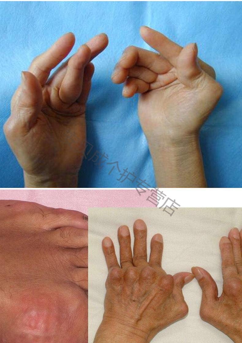 【官方专营】 痛风灵膏贴膏尿酸高类风湿骨关节疼痛专治手指关节疼痛