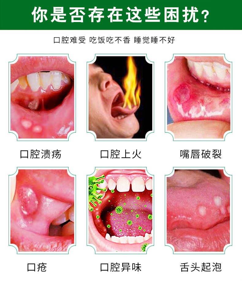 口腔潰瘍噴劑複發性口瘡凝膠噴霧牙膏舌頭上火一點靈兒童口腔潰瘍噴劑