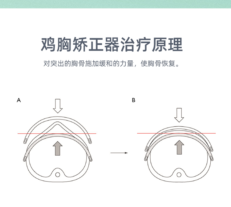 鸡胸支具 价位图片