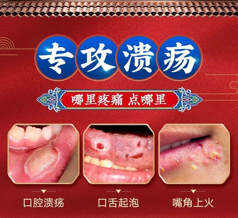 南京同仁堂口腔溃疡液喷雾剂嘴巴唇舌头上火烂口腔溃疡嘴巴舌头起泡生