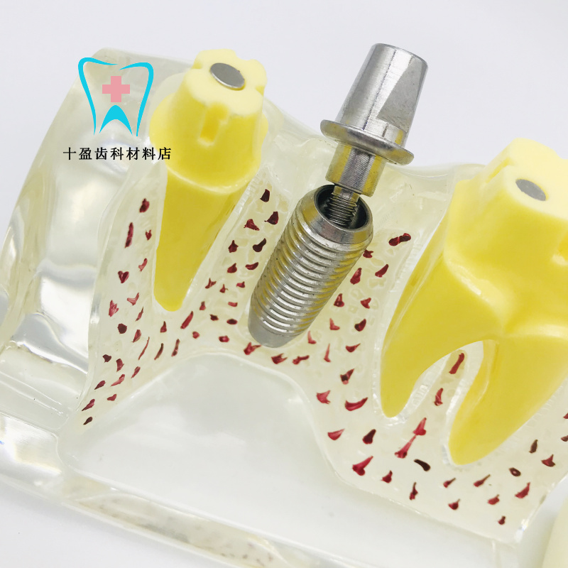 牙科 齿科材料 4倍种植牙解说模型 种植钉 口腔教学医患沟通 透明款