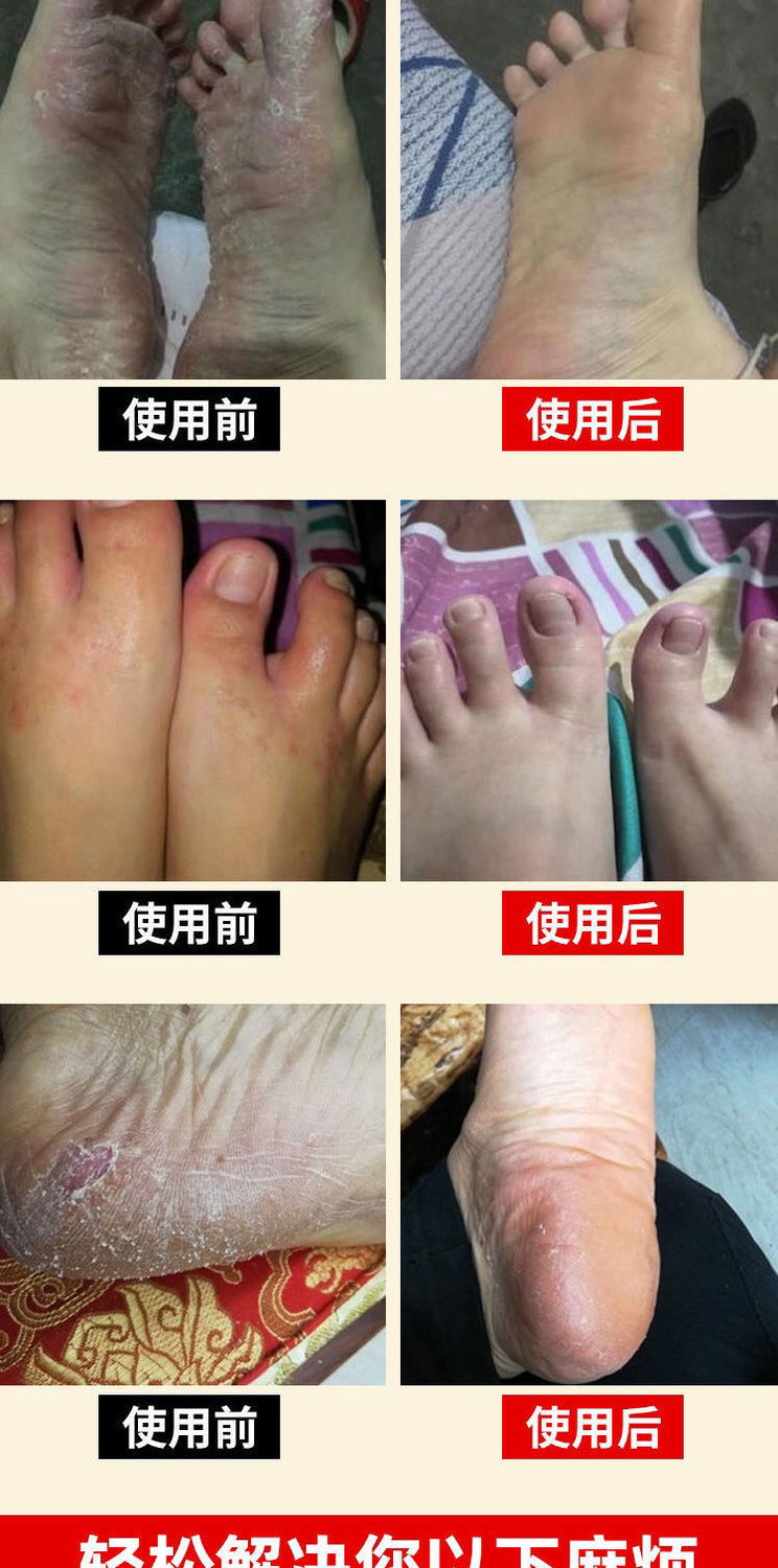 脚气偏方脚气膏脚痒脚气王脚臭脱皮水泡脚丫止痒乳膏护足霜3支装